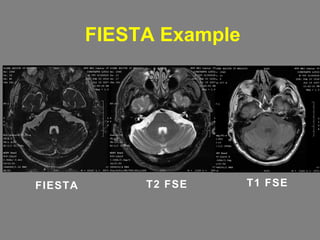 FIESTA Example T2 FSE FIESTA T1 FSE 
