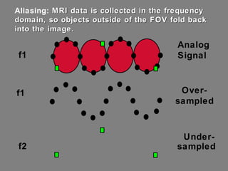 Aliasing:  MRI data is collected in the frequency domain, so objects outside of the FOV fold back into the image. Analog Signal Over- sampled Under- sampled f1 f2 f1 
