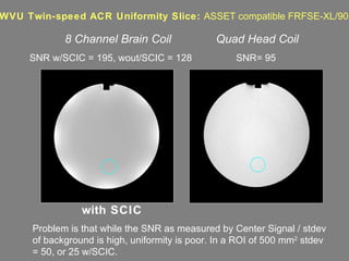 Problem is that while the SNR as measured by Center Signal / stdev of background is high, uniformity is poor. In a ROI of 500 mm 2  stdev = 50, or 25 w/SCIC.  WVU Twin-speed ACR Uniformity Slice:  ASSET compatible FRFSE-XL/90 with SCIC 8 Channel Brain Coil Quad Head Coil SNR w/SCIC = 195, wout/SCIC = 128 SNR= 95 