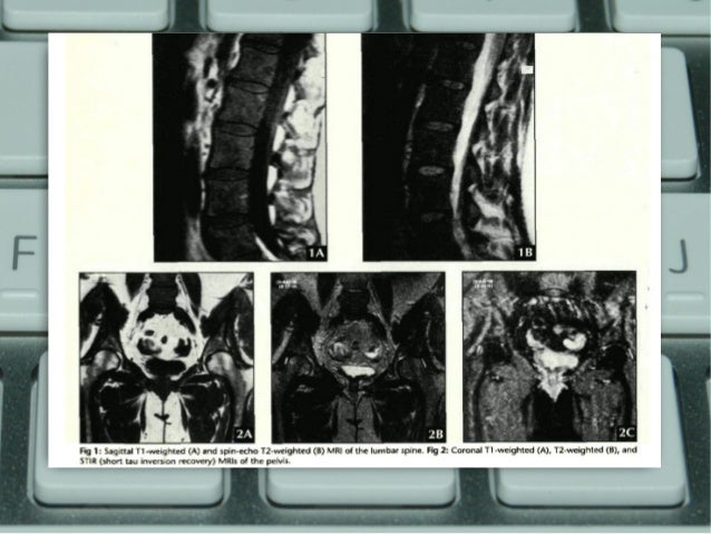 Stroke mri case study picture