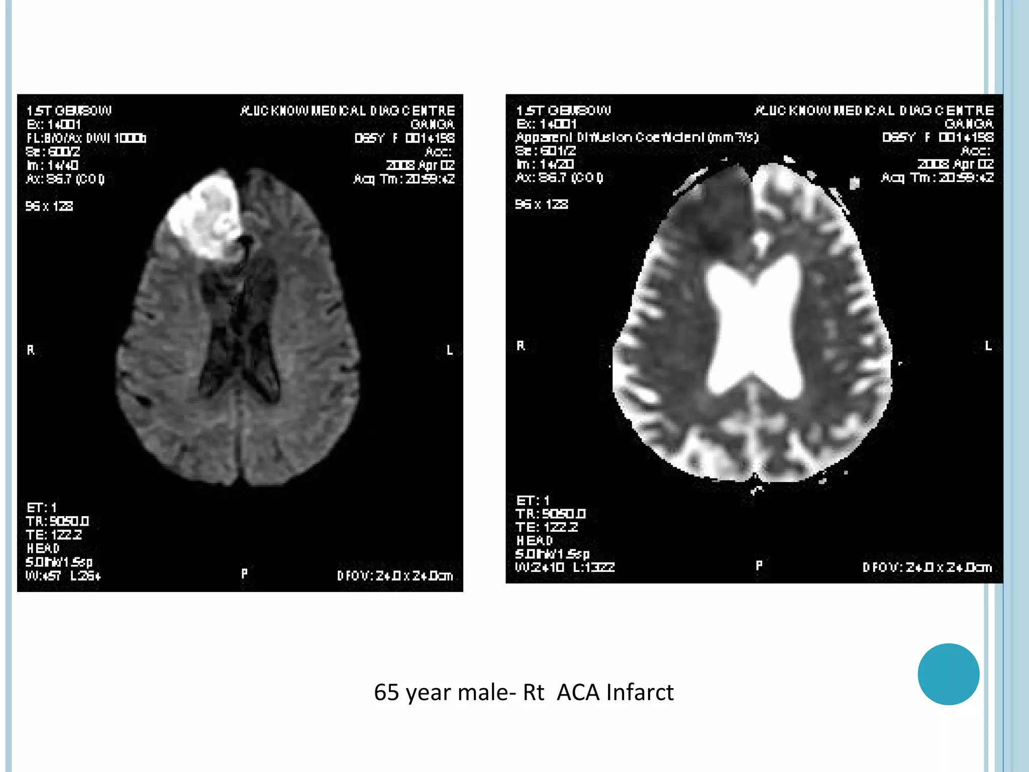 65 year male- Rt ACA Infarct
 