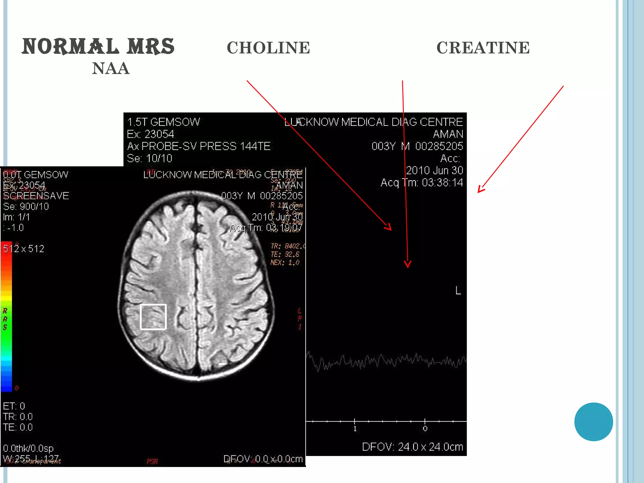 NORMAL MRS   CHOLINE   CREATINE
    NAA
 