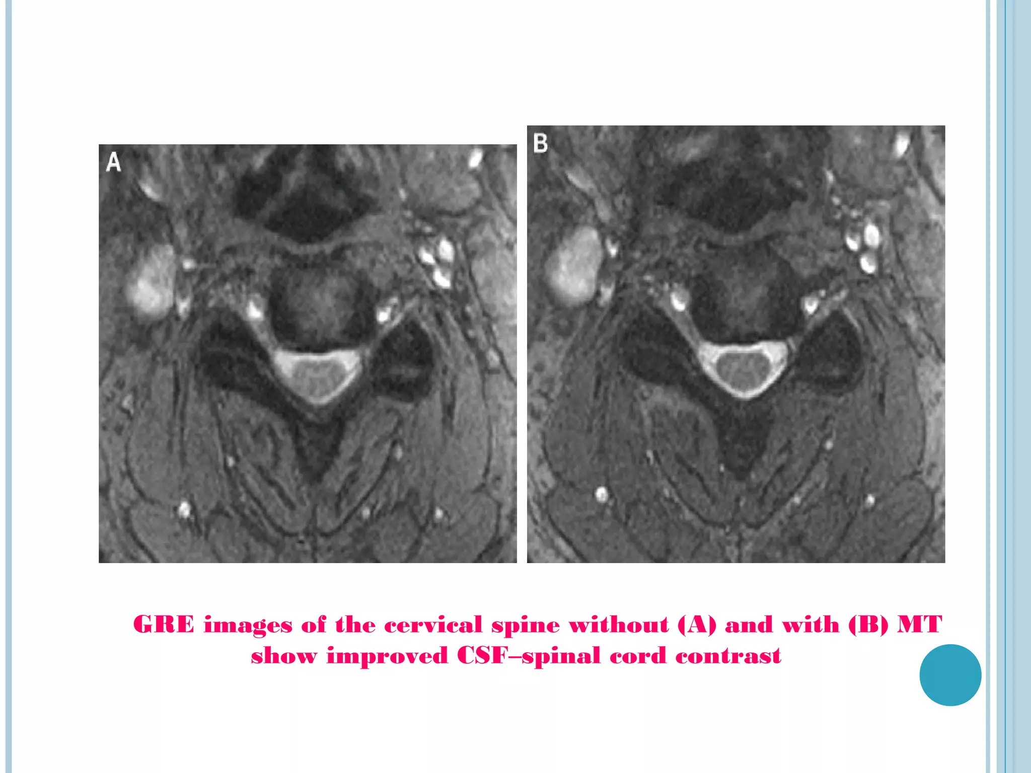 GRE images of the cervical spine without (A) and with (B) MT
       show improved CSF–spinal cord contrast
 