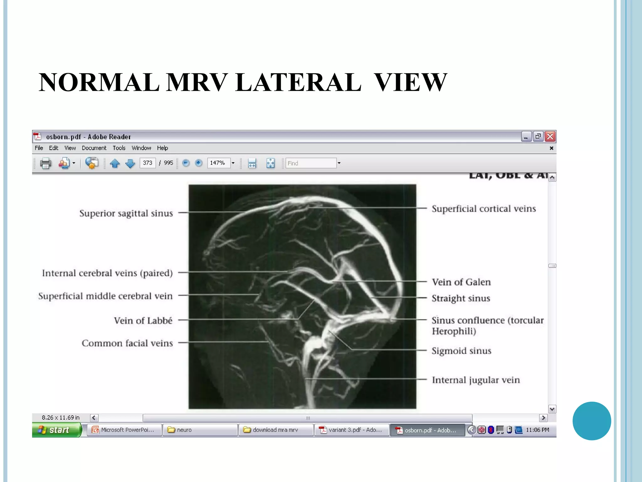 NORMAL MRV LATERAL VIEW
 