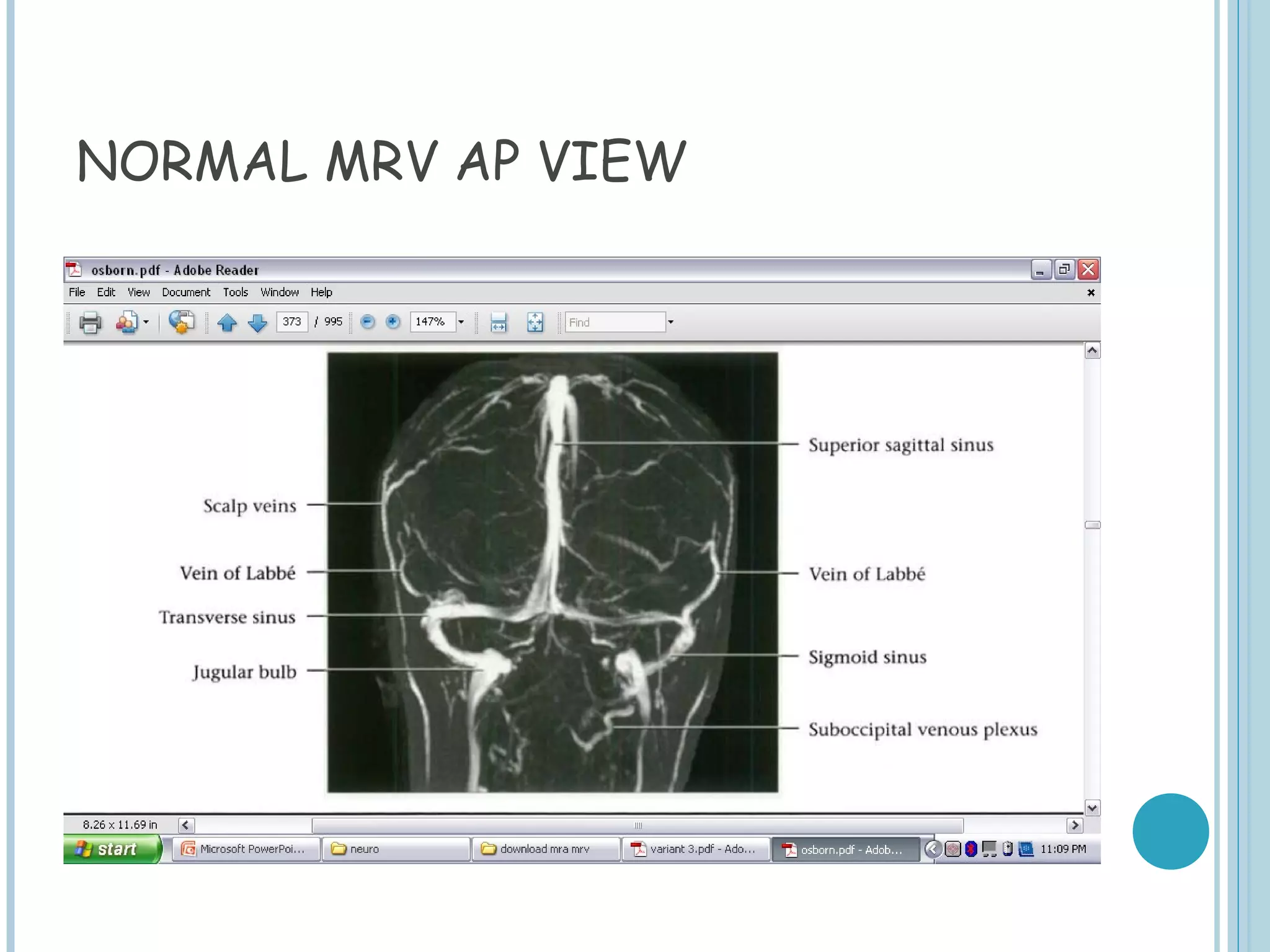 NORMAL MRV AP VIEW
 