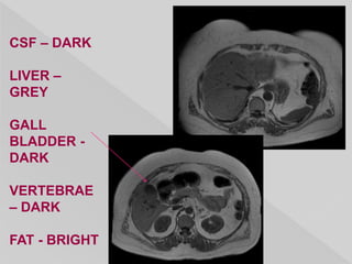 CSF – DARK
LIVER –
GREY
GALL
BLADDER -
DARK
VERTEBRAE
– DARK
FAT - BRIGHT
 