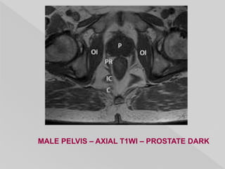 MALE PELVIS – AXIAL T1WI – PROSTATE DARK
 