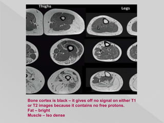 Bone cortex is black – it gives off no signal on either T1
or T2 images because it contains no free protons.
Fat – bright
Muscle – Iso dense
 