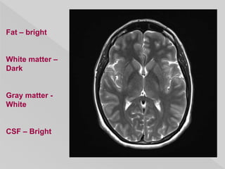 Fat – bright
White matter –
Dark
Gray matter -
White
CSF – Bright
 