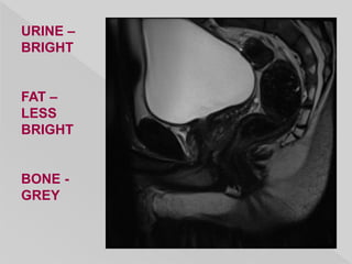 URINE –
BRIGHT
FAT –
LESS
BRIGHT
BONE -
GREY
 