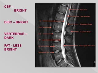 CSF –
BRIGHT
DISC – BRIGHT
VERTEBRAE –
DARK
FAT - LESS
BRIGHT
 