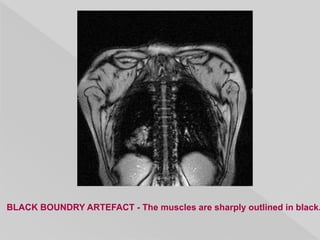 BLACK BOUNDRY ARTEFACT - The muscles are sharply outlined in black.
 