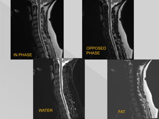 IN PHASE
OPPOSED
PHASE
WATER FAT
 