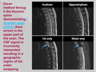 Dixon
method throug
h the thoracic
spine
demonstrating f
at-water swap
artifact (blue
arrow) in the
upper part of
the scan. The
CSF signal is
incorrectly
interpreted
resulting in a
geographic
region of fat-
water
swapping.
 
