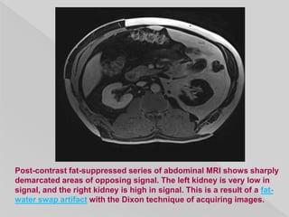 Post-contrast fat-suppressed series of abdominal MRI shows sharply
demarcated areas of opposing signal. The left kidney is very low in
signal, and the right kidney is high in signal. This is a result of a fat-
water swap artifact with the Dixon technique of acquiring images.
 