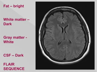 Fat – bright
White matter –
Dark
Gray matter -
White
CSF – Dark
FLAIR
SEQUENCE
 