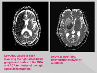 CENTRAL DIFFUSION
RESTRICTION IN CASE OF
ABSCESS
Low ADC values is seen
involving the right-sided basal
ganglia and cortex of the MCA
and ACA territories of the right
cerebral hemisphere.
 