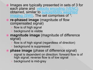  Images are typically presented in sets of 3 for
each plane and velocity encoding (VENC)
obtained, similar to susceptibility weighted
imaging (SWI). The set comprises of 1:
 re-phased image (magnitude of flow
compensated signal)
› flow is of high signal
› background is visible
 magnitude image (magnitude of difference
signal)
› flow is of high signal (regardless of direction)
› background is suppressed
 phase image (phase of difference signal)
› signal is dependent on direction: forward flow is of
high signal; reverse flow is of low signal
› background is mid-grey
 