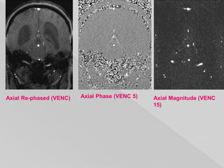 Axial Re-phased (VENC) Axial Phase (VENC 5) Axial Magnitude (VENC
15)
 