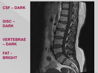 CSF – DARK
DISC –
DARK
VERTEBRAE
– DARK
FAT -
BRIGHT
 