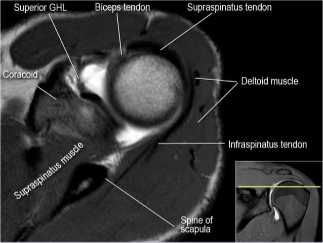 MRI sholdure
