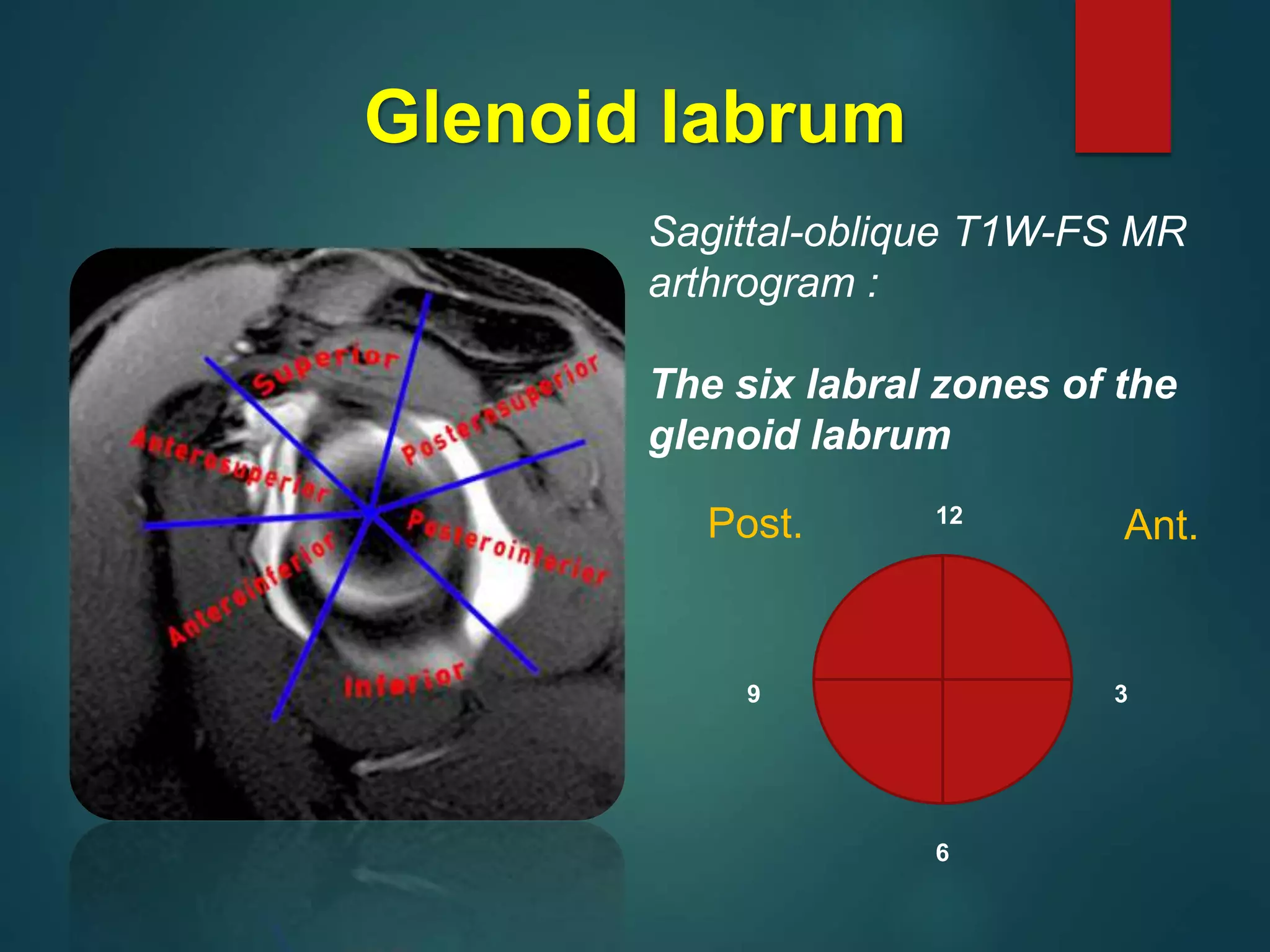 Labrum Mri Arthrogram MRI of the shoulder | PPTX