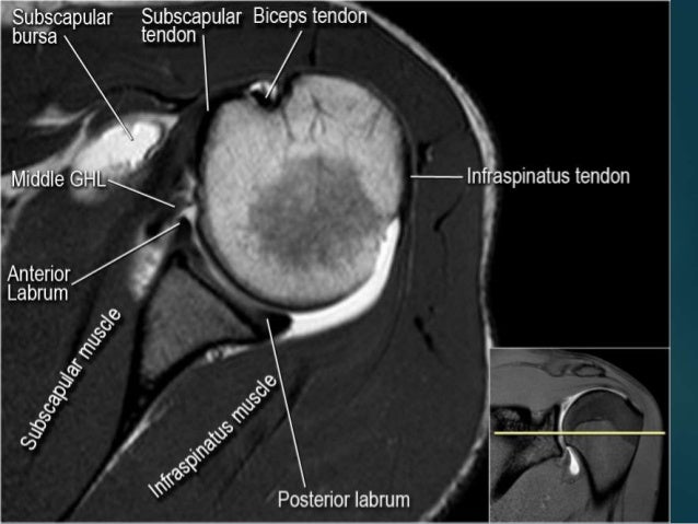 rotator cuff tear mri