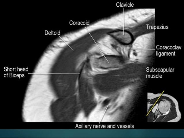 rotator cuff tear mri