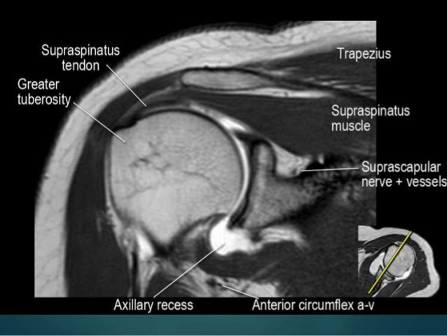 rotator cuff tear mri