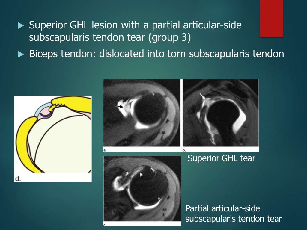 MRI of the shoulder