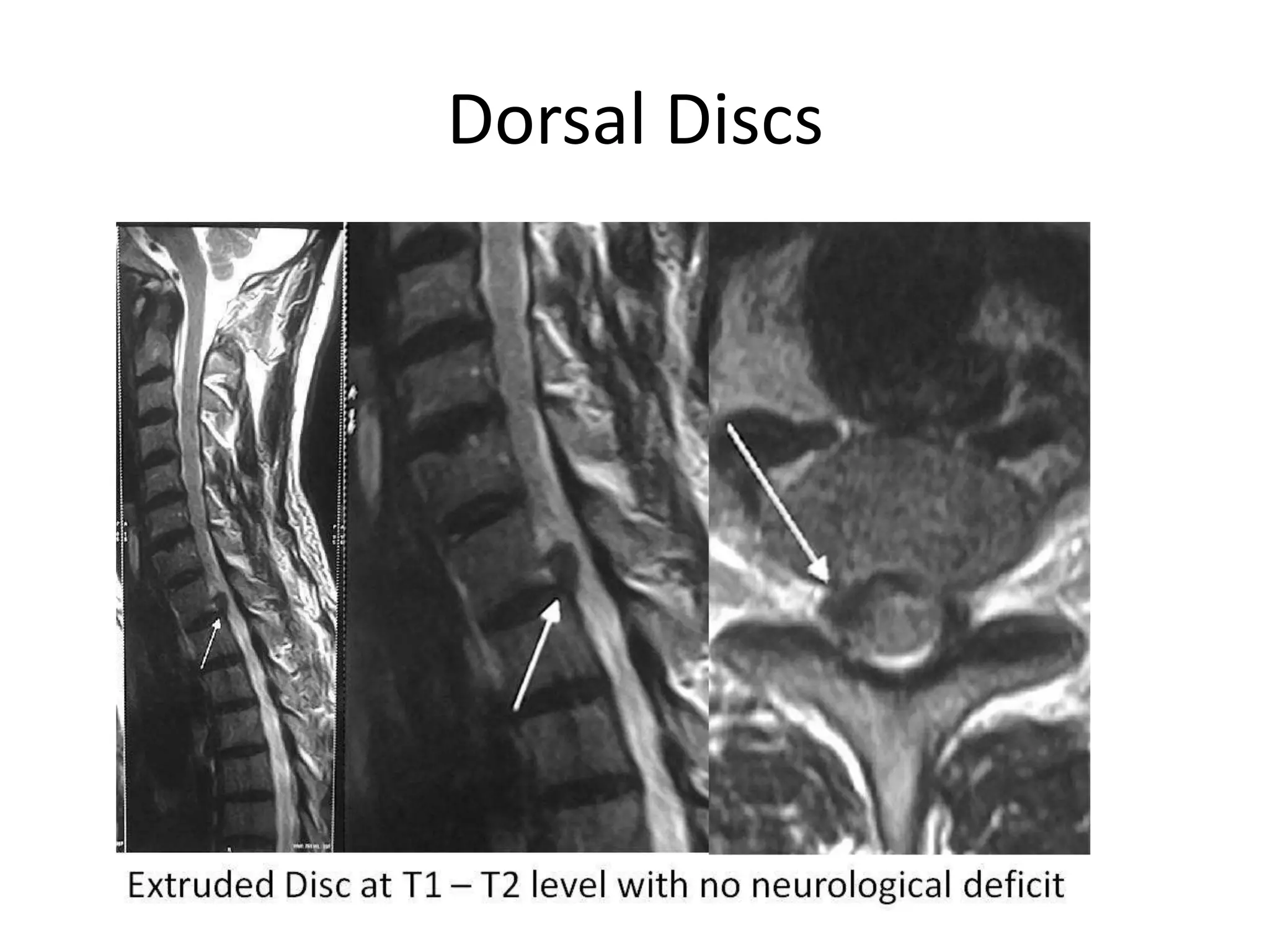 Dorsal Discs