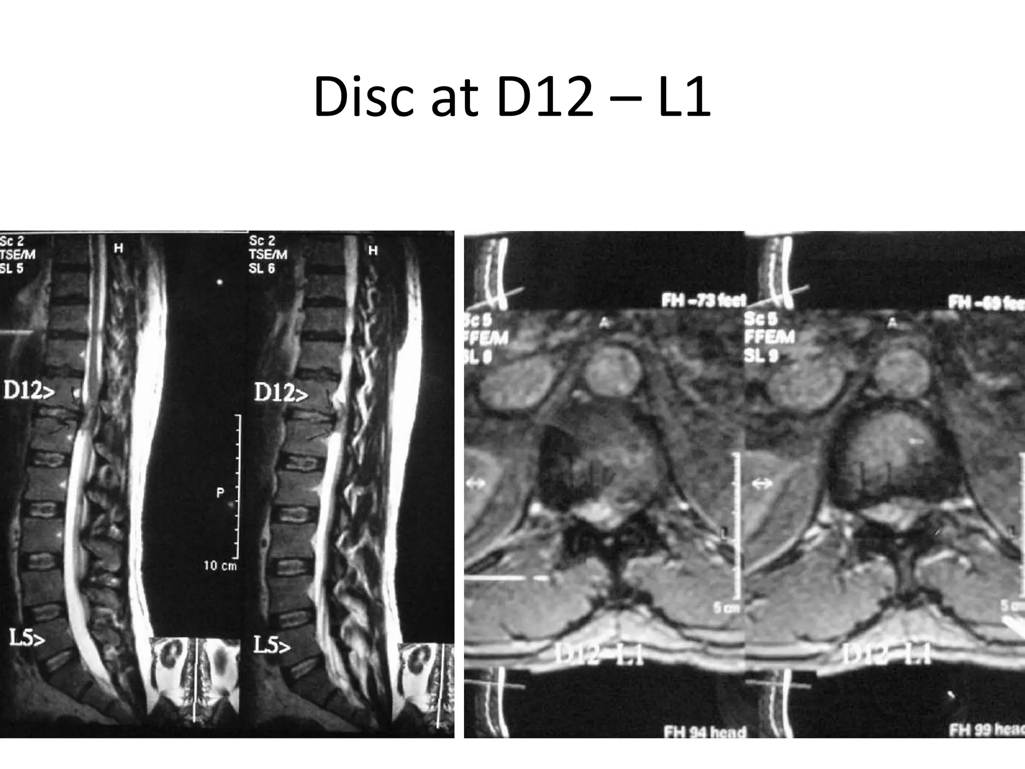 Disc at D12 – L1