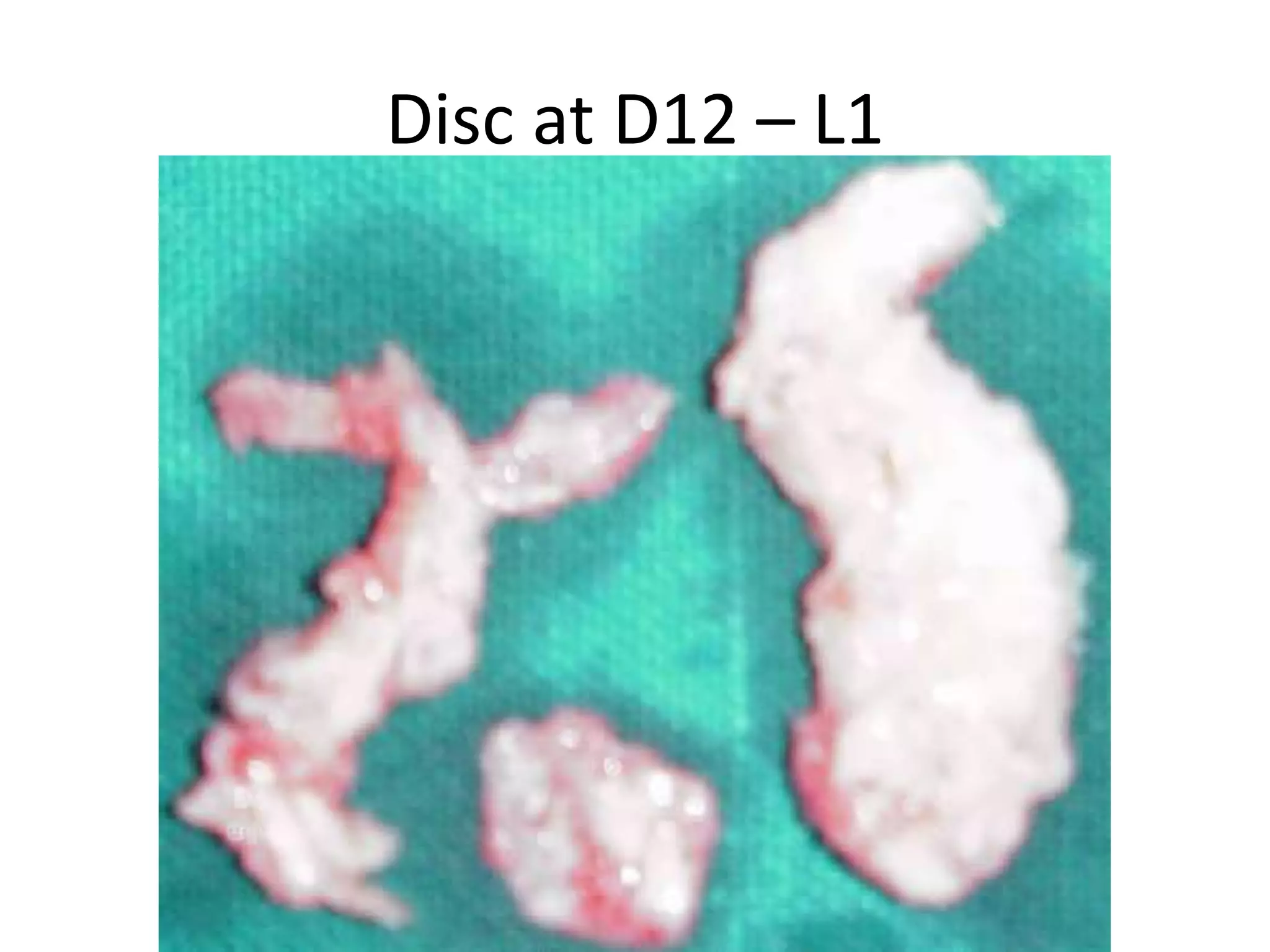 Disc at D12 – L1