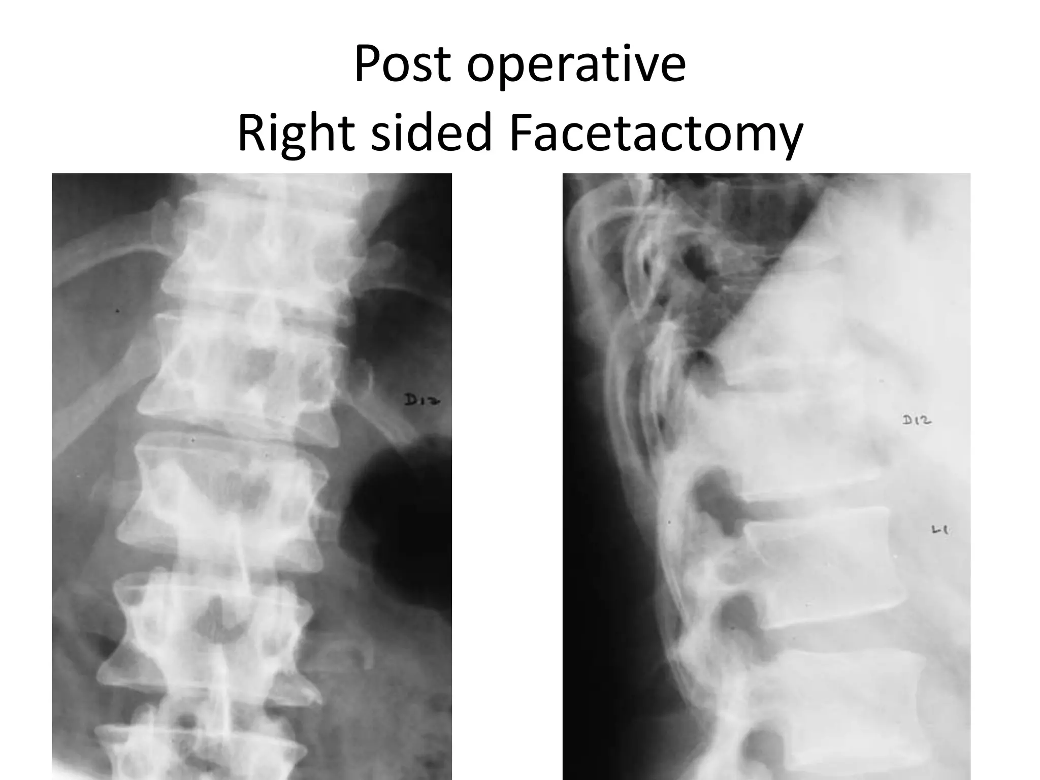 Post operative Right sided Facetactomy
