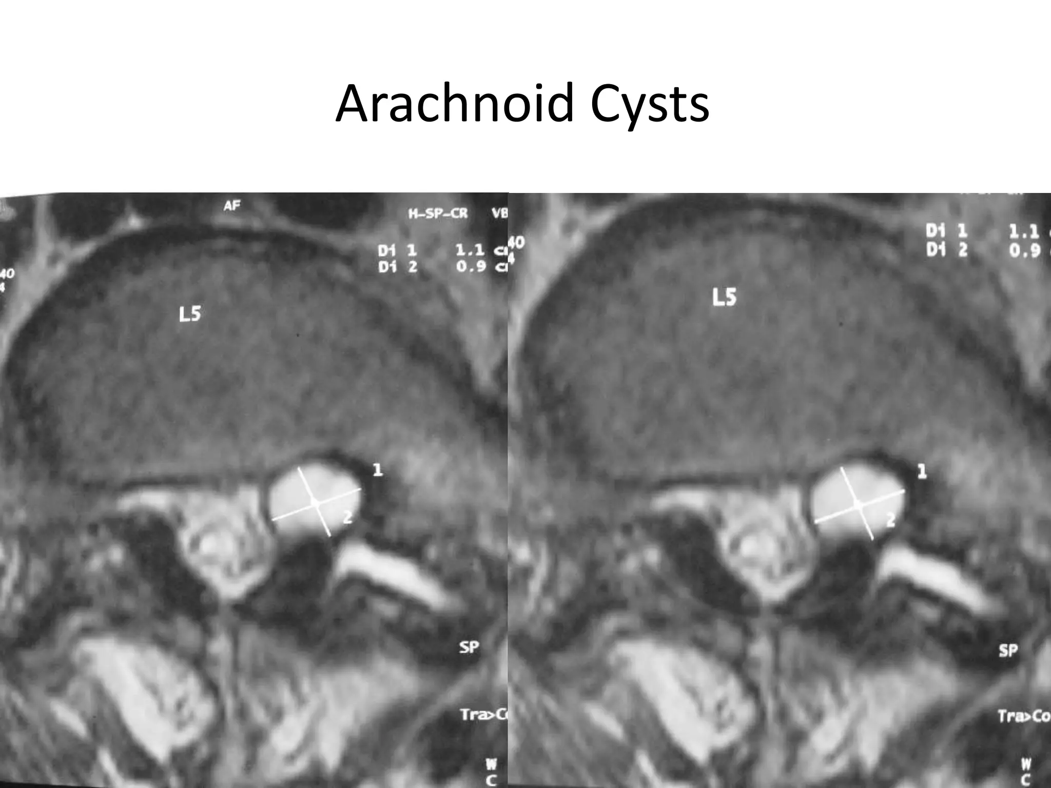 Arachnoid Cysts