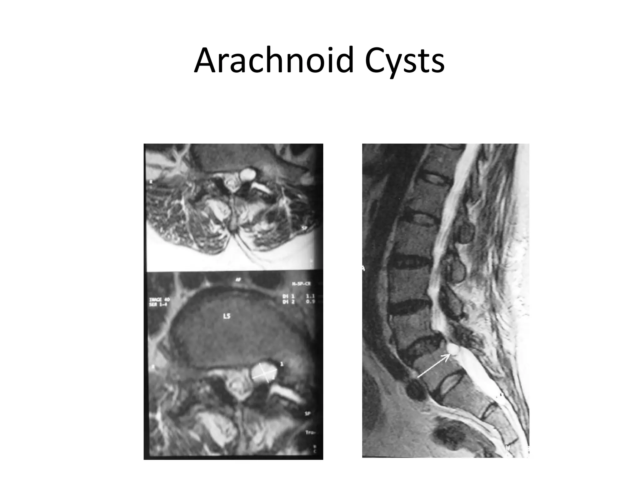 Arachnoid Cysts