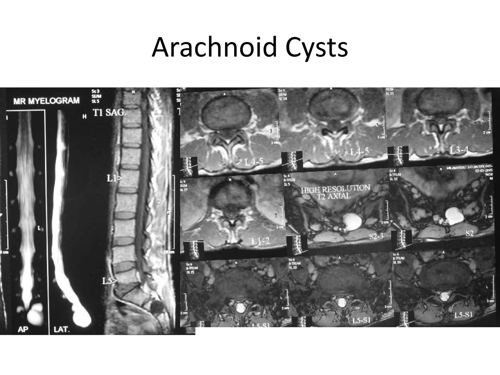 Arachnoid Cysts
