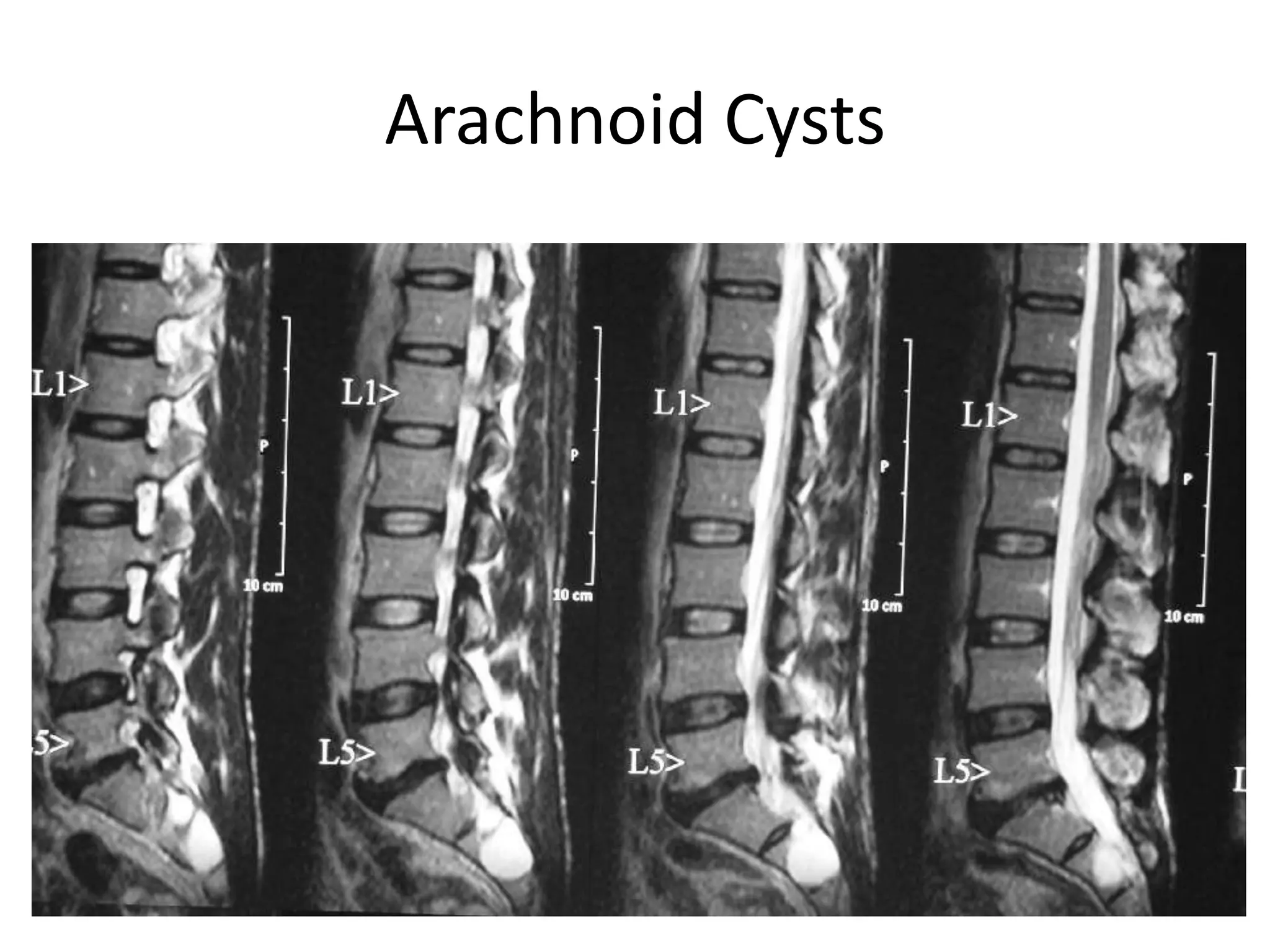 Arachnoid Cysts