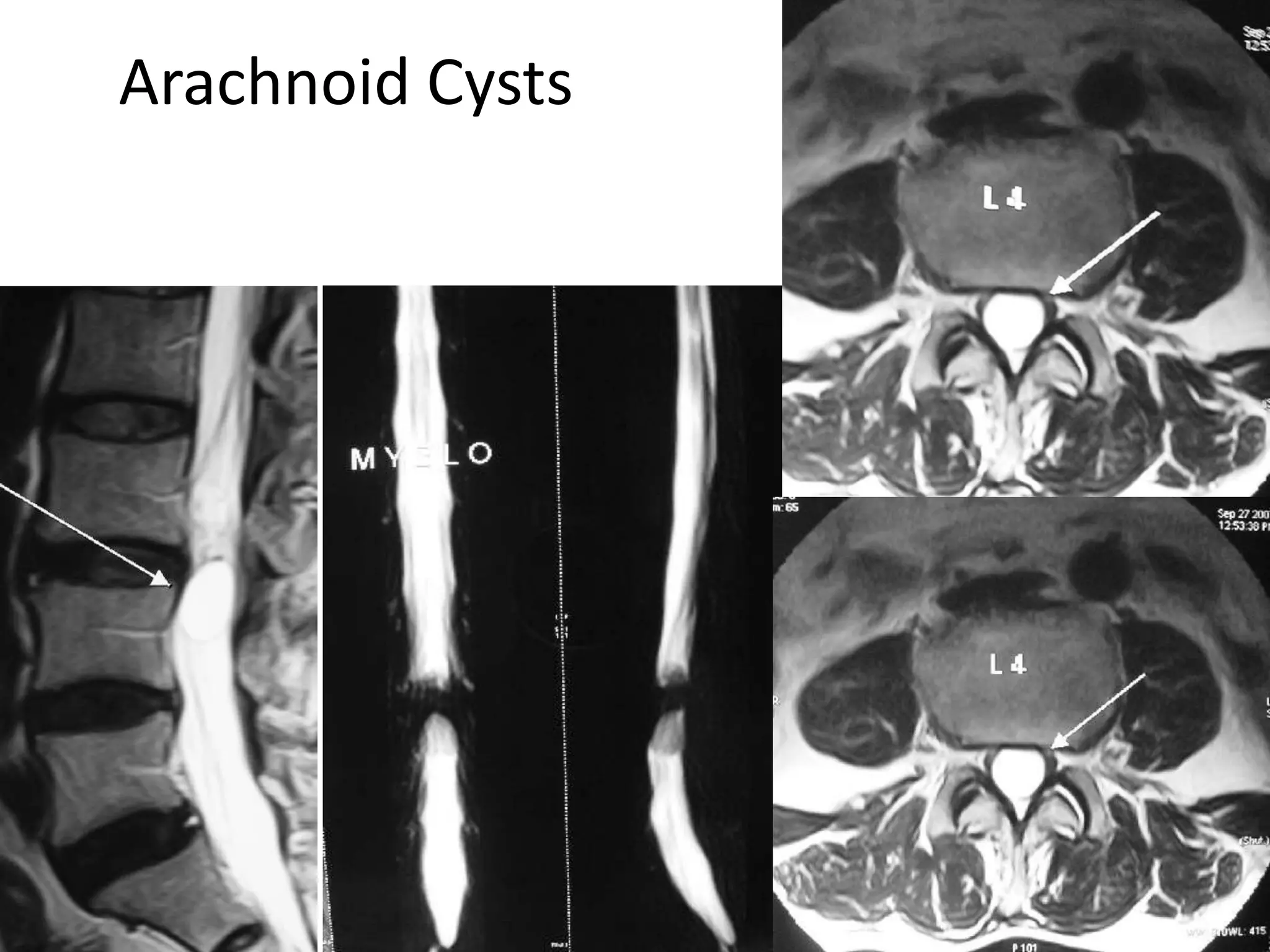 Arachnoid Cysts