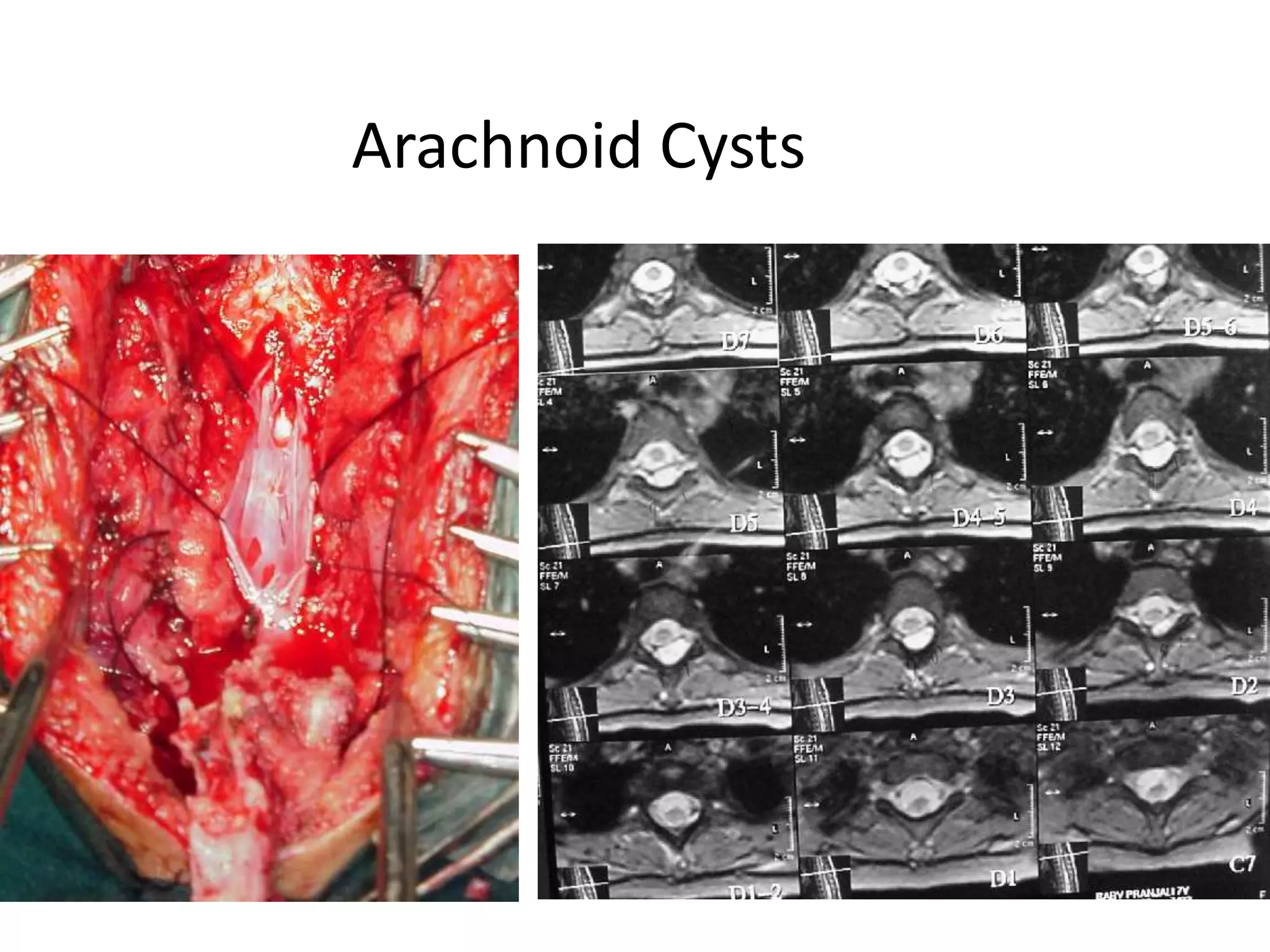 Arachnoid Cysts