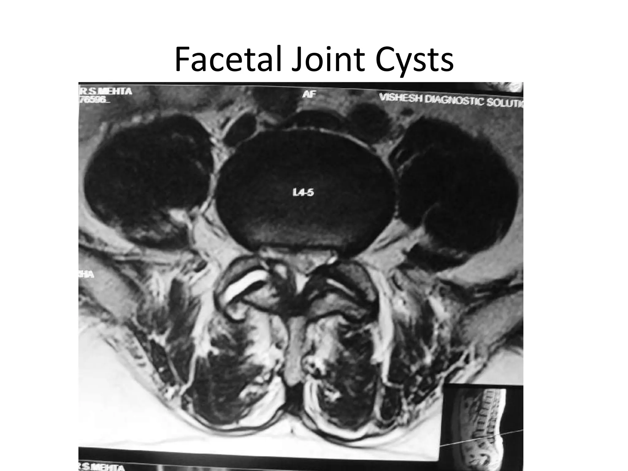 Facetal Joint Cysts