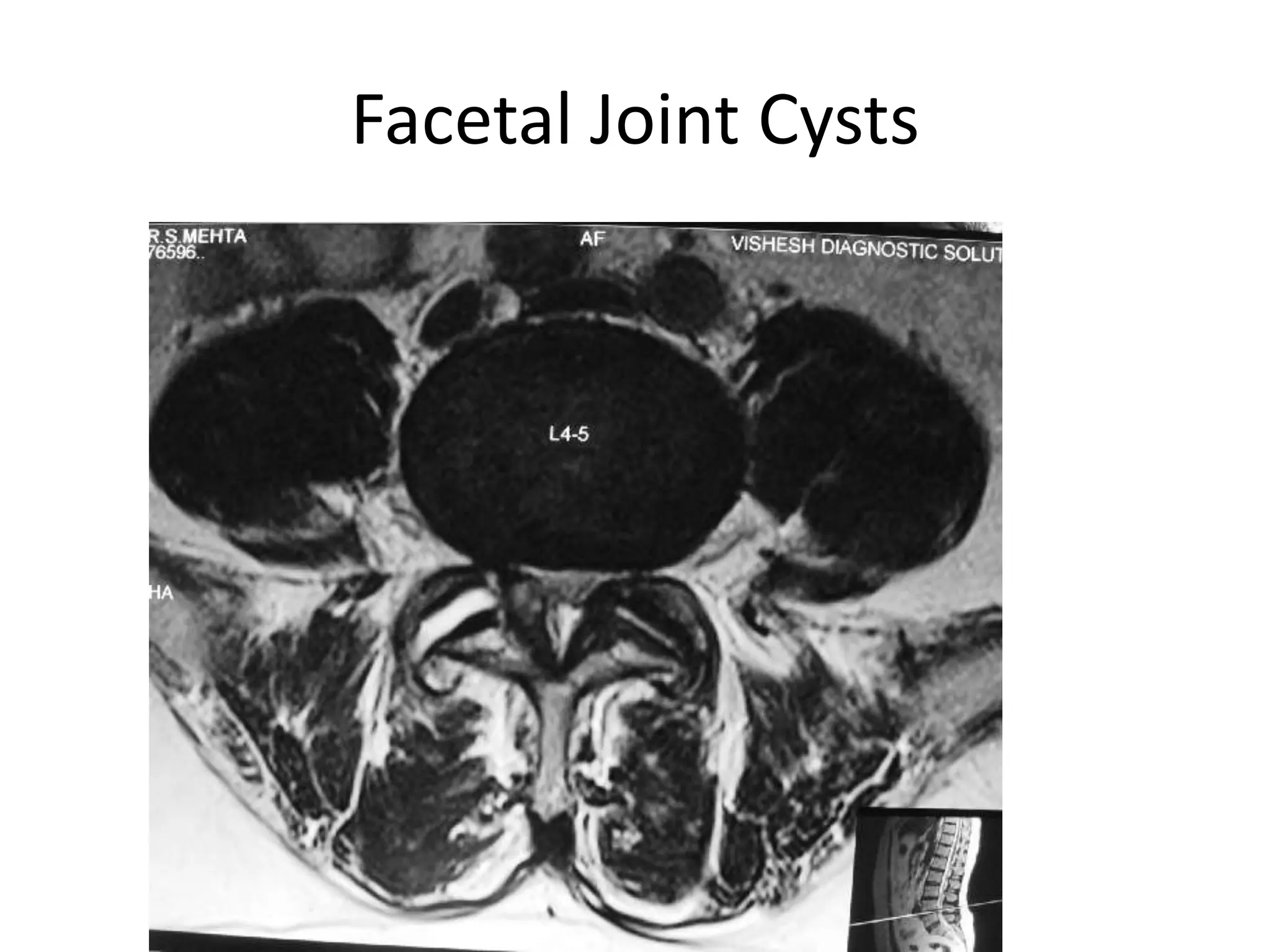 Facetal Joint Cysts