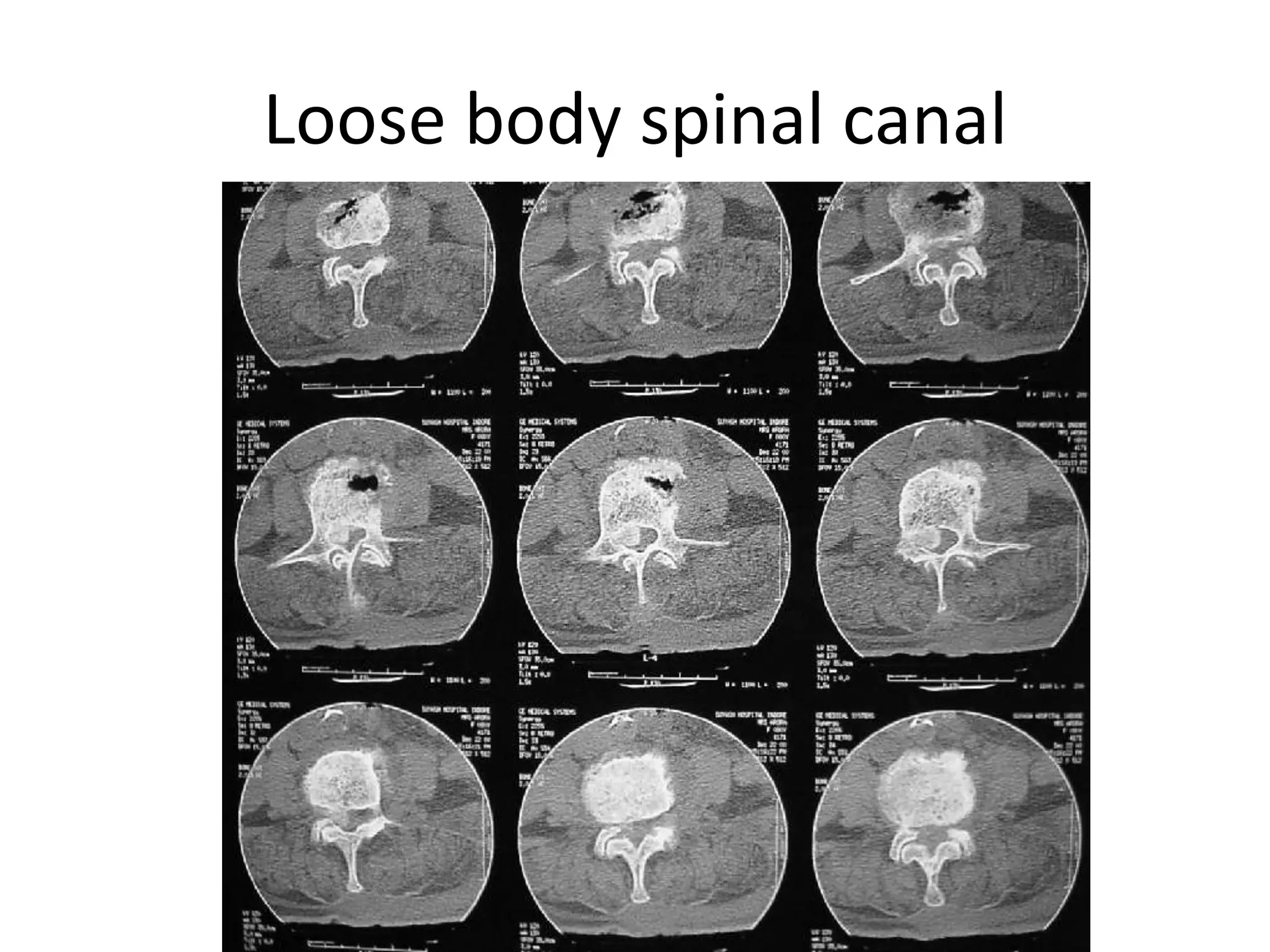 Loose body spinal canal