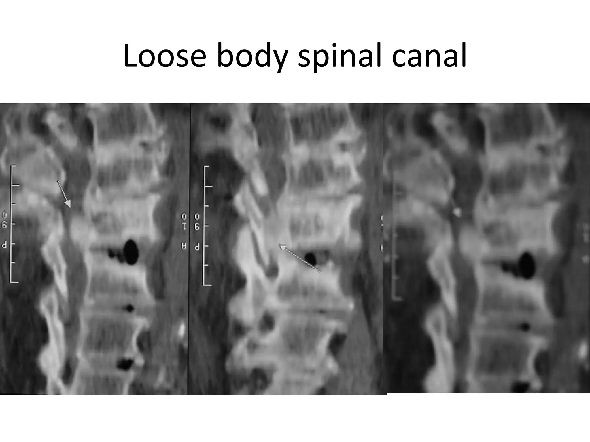 Loose body spinal canal