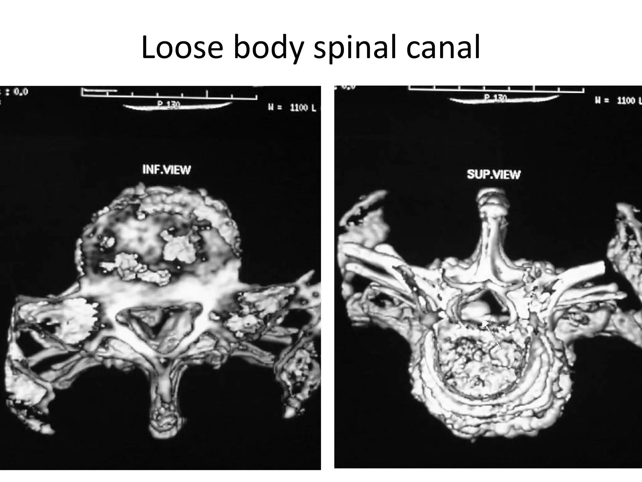 Loose body spinal canal