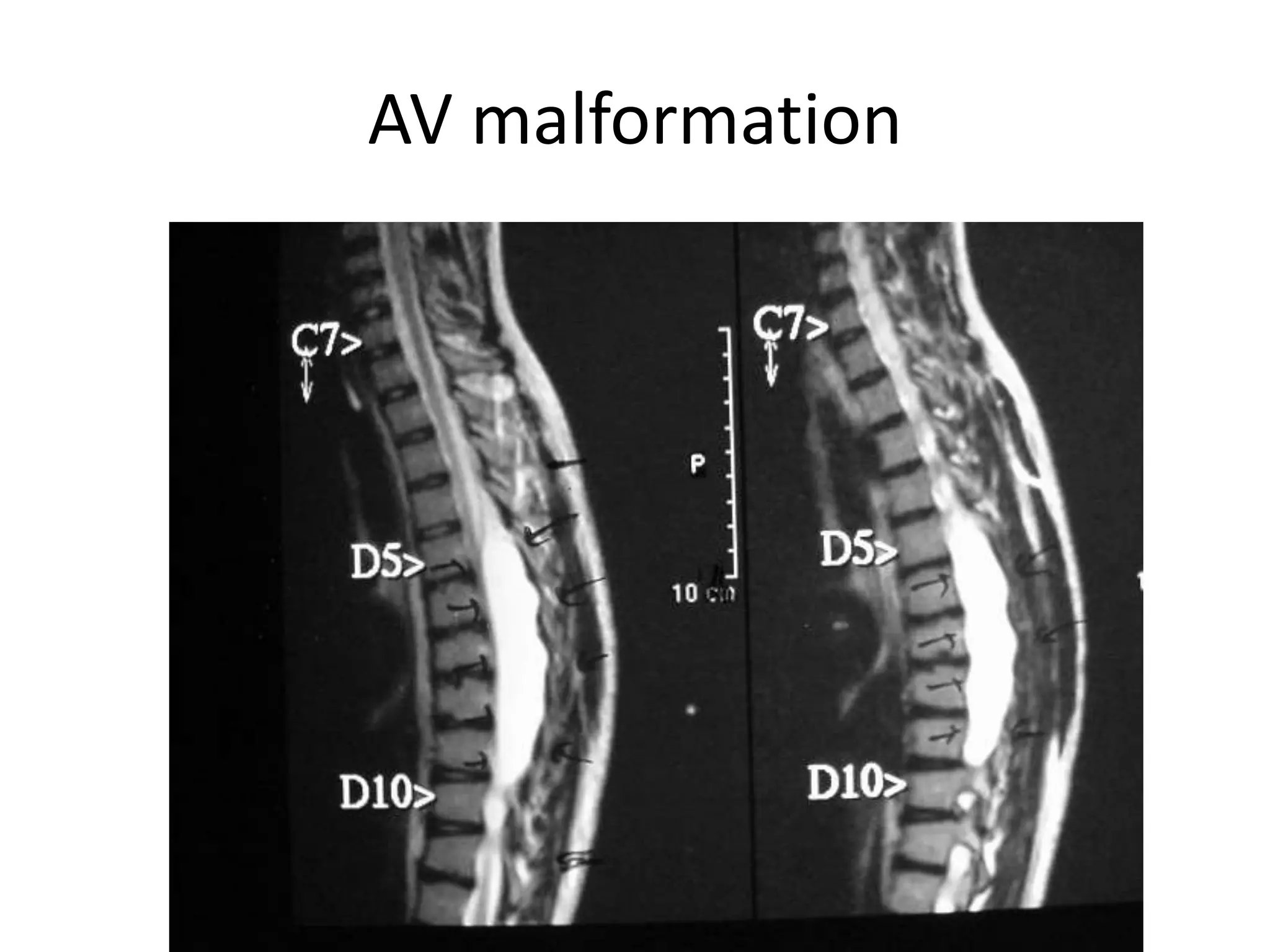 AV malformation