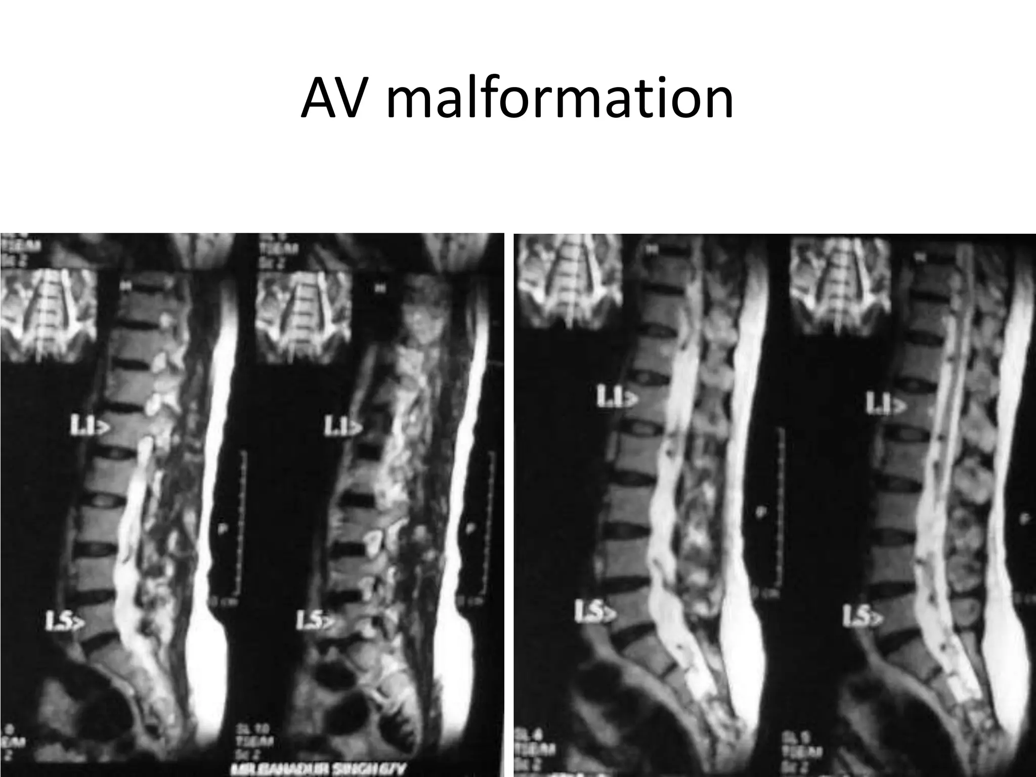 AV malformation