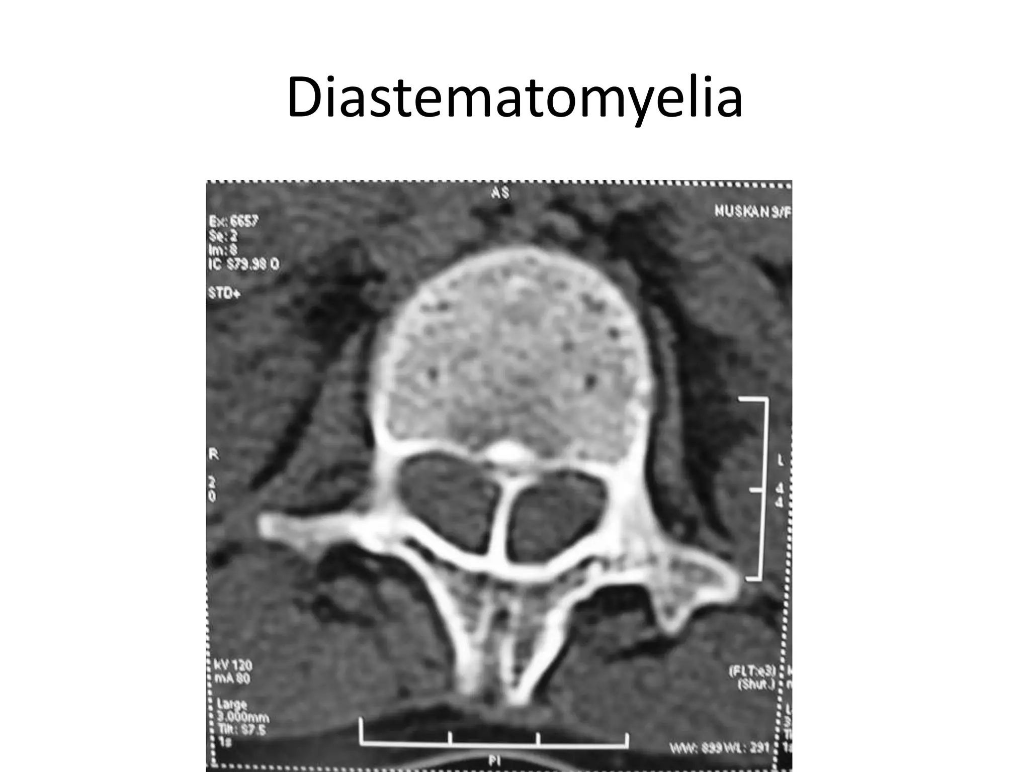 Diastematomyelia