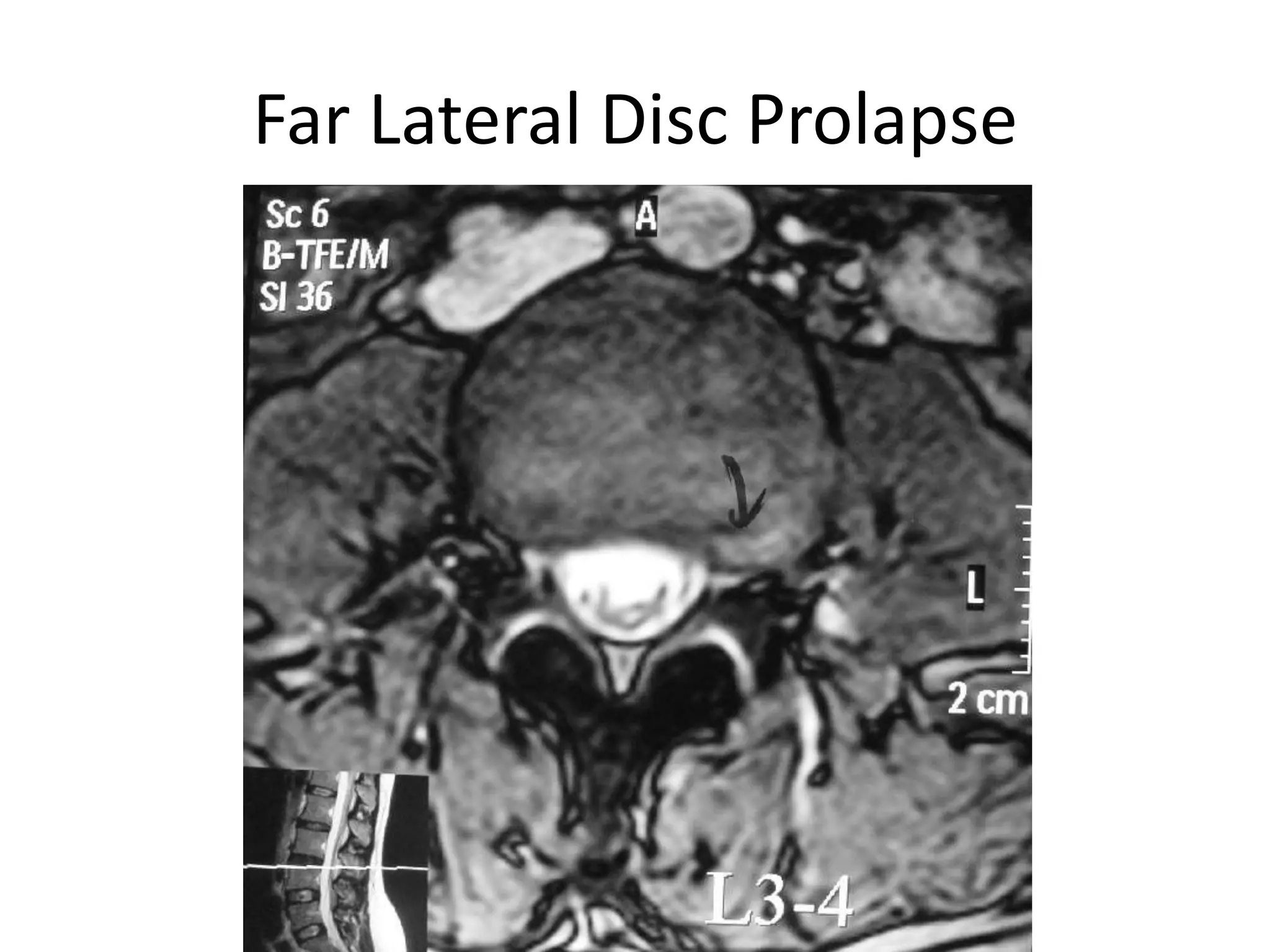 Far Lateral Disc Prolapse