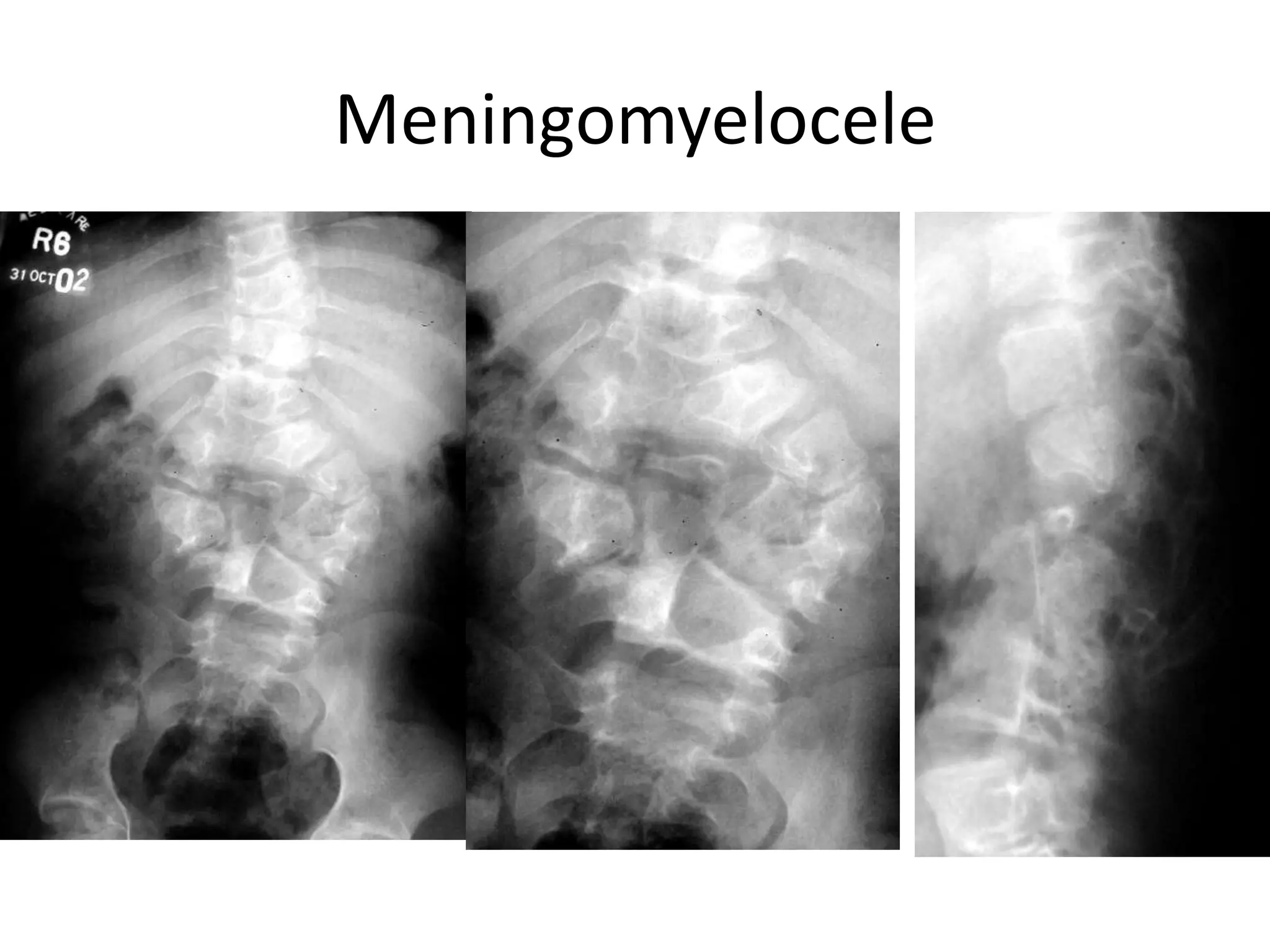 Meningomyelocele
